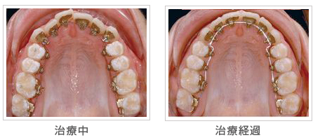 カスタムメイド型リンガルブラケット矯正装置（インコグニト　リンガル　アプライアンス　システム）：症例